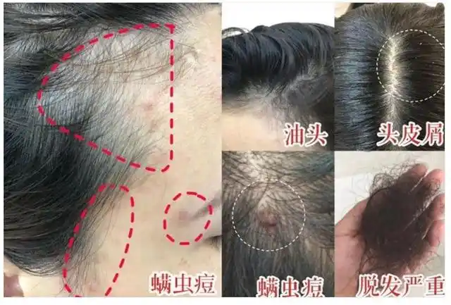 会钻进你的皮肤,毛孔螨虫,是很可怕的一个过过敏源换季期间的螨虫繁殖