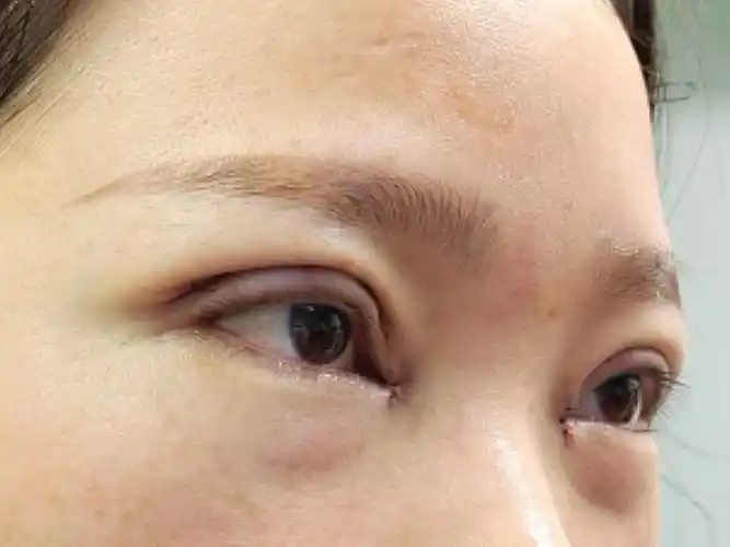 【术前分析】:眼皮下垂,双眼皮不明显,不对称,肿泡_圈子-新氧美容整形