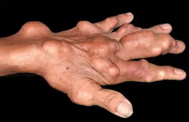 尿酸高有哪些症状(尿酸偏高就一定会得痛风?)-第2张图片