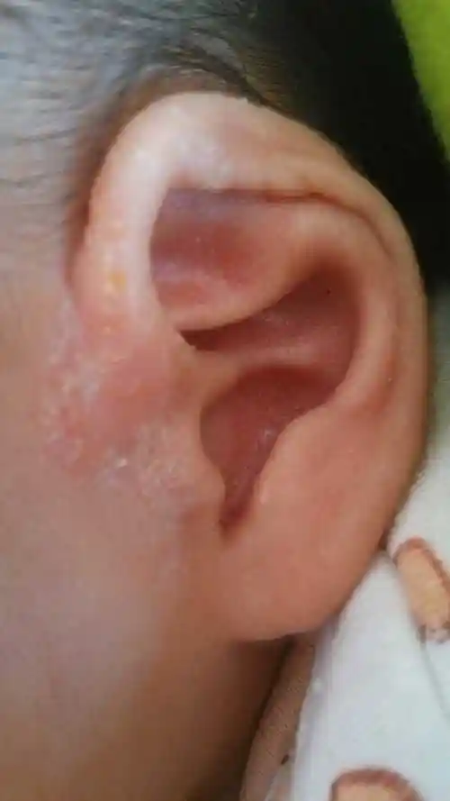 宝宝耳朵边流黄水结痂,有什么方法能治疗,这个是湿疹吗