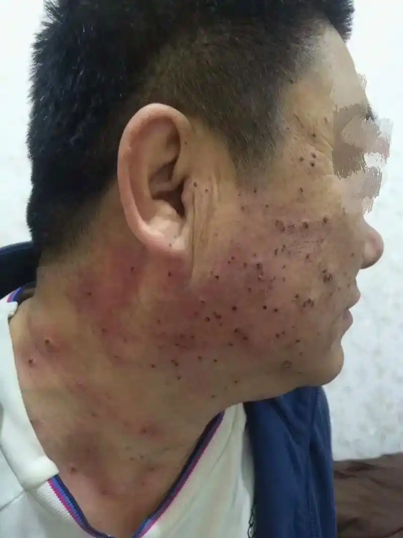 同城精选话题 #痣的含义 #皮肤问题 ##同款痣疣去除 # - 抖音