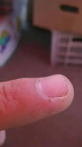 问:我被小老鼠咬伤一点,有图,但是会咋么样,很急,求回答