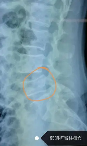 骨折,滑脱,突出.椎间孔镜,经皮椎弓根螺钉,微创杂交手术解烦忧