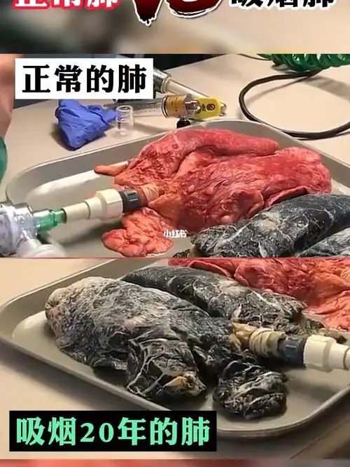 正常人的肺和吸烟20年的肺