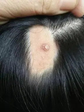 长沙一男子头上的胎记长出会长大的"肉痣",医生却这样说……_皮脂腺