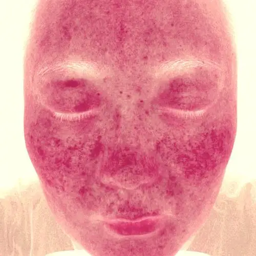 晒伤后激素皮肤