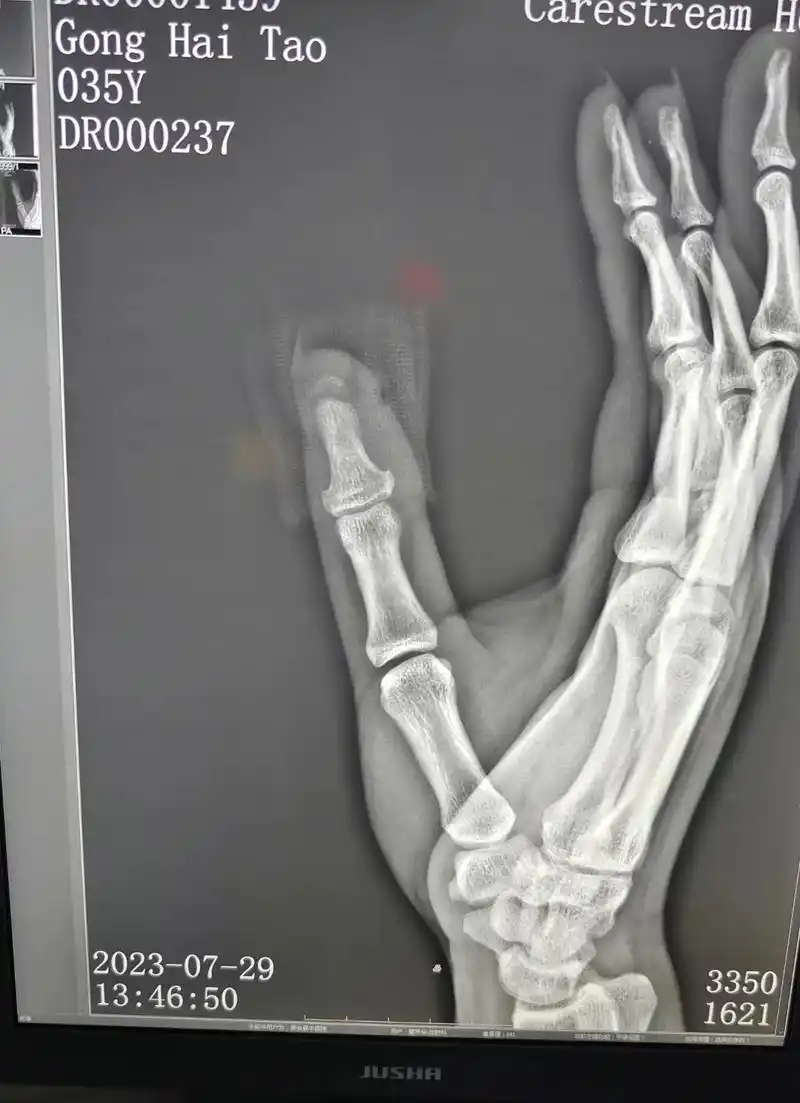 这些全是手指远端骨折.工伤劳动能力鉴定.都是10级 赔偿都在 - 抖音