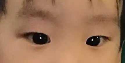 孩子突然斗鸡眼只能手术吗对话彭海鹰打一针可以治疗