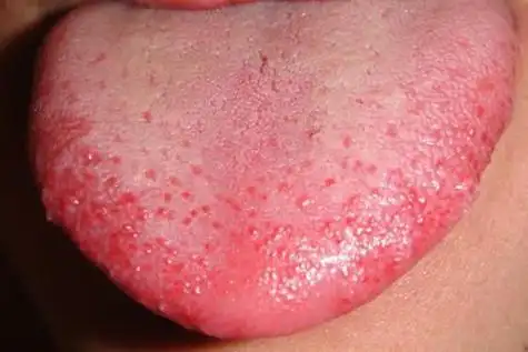 医生一看他脸上红疙瘩连成片,让他伸出来舌头看一下,随后又把脉.