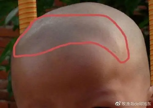 d罹患佝偻病,会使这一过程减慢,你手摸宝宝的头部软乎乎的,有凹陷