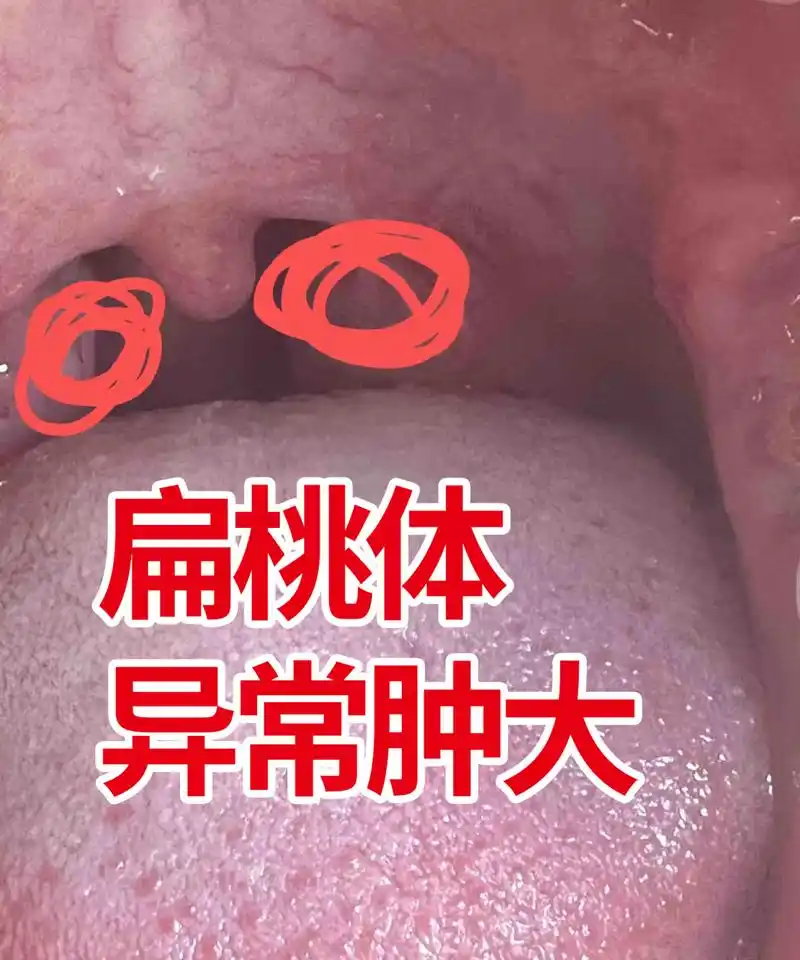 扁桃体单侧的肿大,我话说在前头,一发现就要尽快就医,等不得!