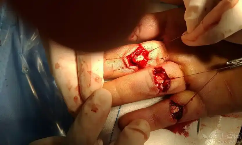 右手刀切伤 [病例帖]