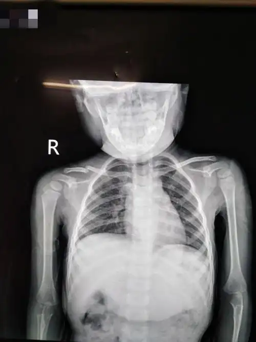 小儿锁骨骨折克氏针内固定