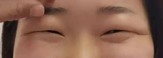 最适合肿眼泡的双眼皮类型