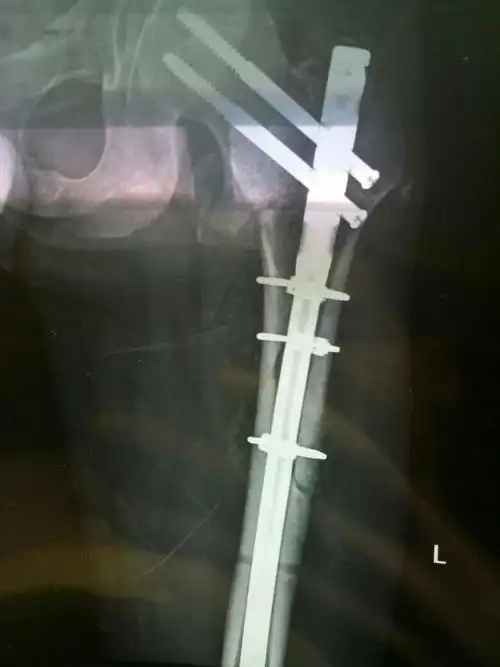 大腿股骨骨折,现在手术两个月了,大家帮我看一下有没有骨痂生长?