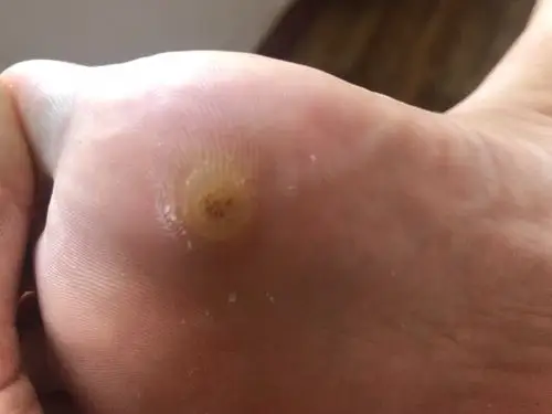 这个是血泡刺么