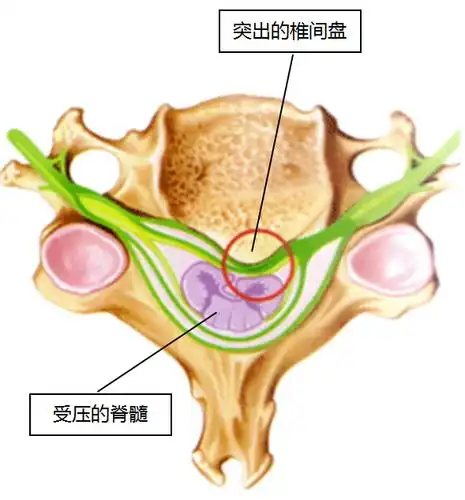 什么是颈椎病你可能真心了解得不多