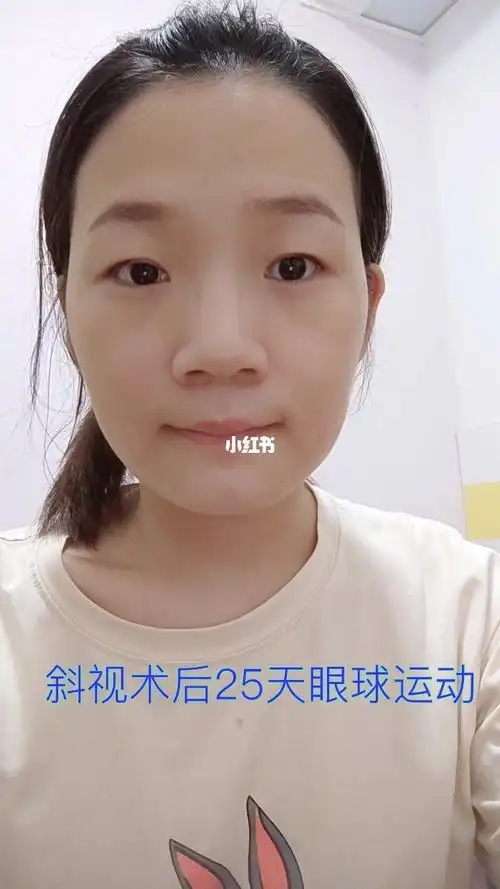 斜视手术就是这样#变瘦变美变好看最近很多姐妹跟我聊天,问我恢复的