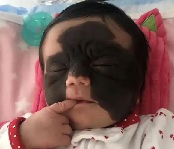 还记得天生胎记酷似"蝙蝠侠"的女婴吗?