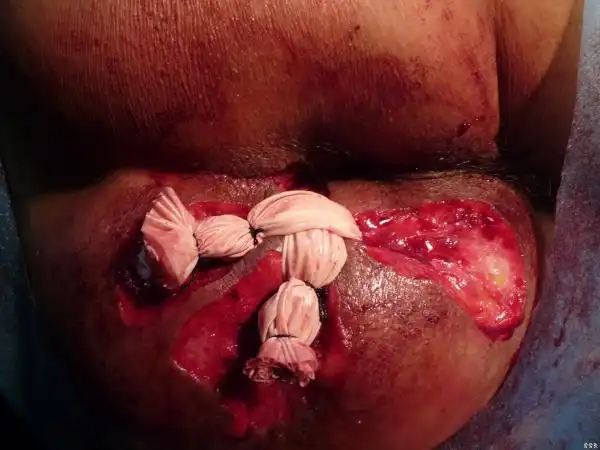 楼主于庆利2011-04-19 13:26:31这例病人两年前在外院手术后三个月