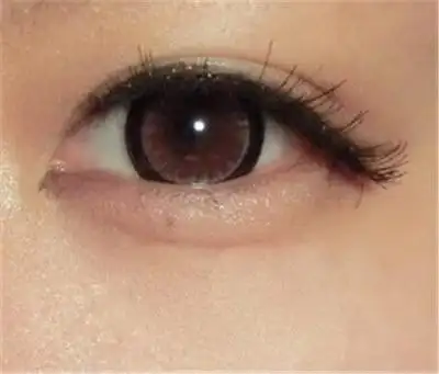 下眼睑整形优惠价格,需要多少钱?