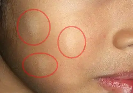 娃脸上惊现白斑有虫?还是白癜风?家长莫慌,可能白色糠疹在作怪
