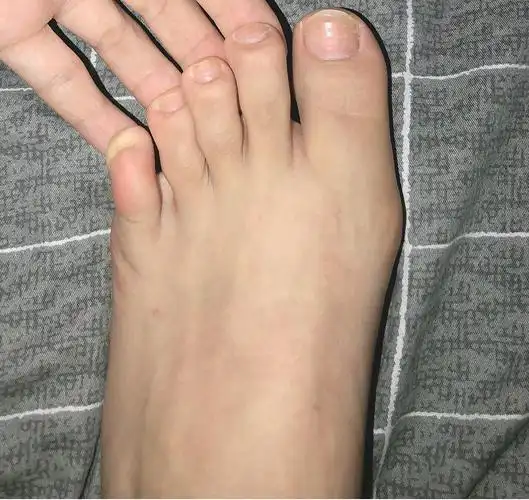 我的脚拇指绝了
