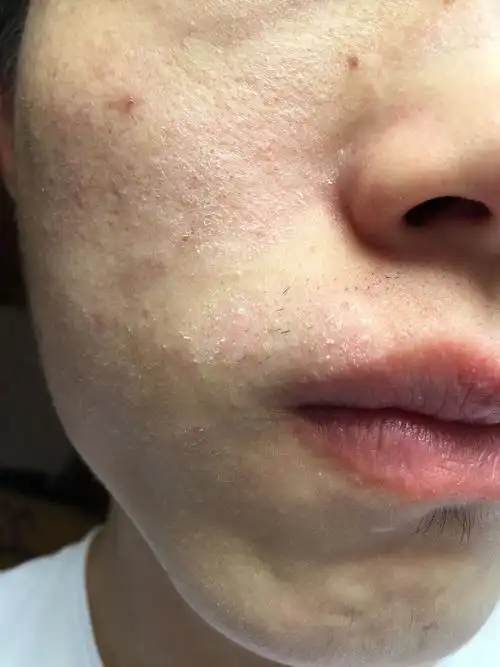 脸上干,脱屑,一直不见好,是不是什么皮肤病?_百度知道