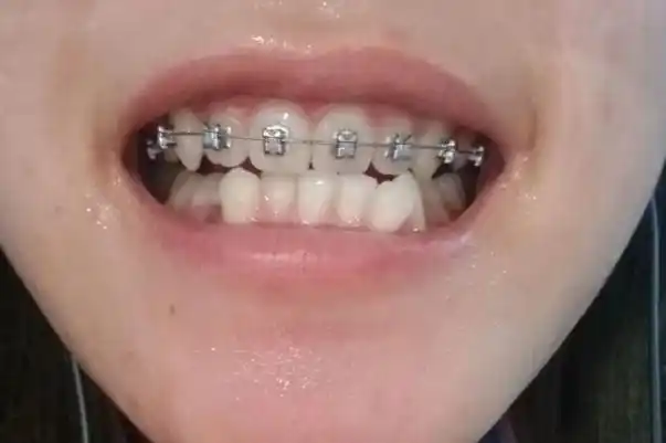 牙套多大年龄可以戴3岁小孩可以戴牙套吗