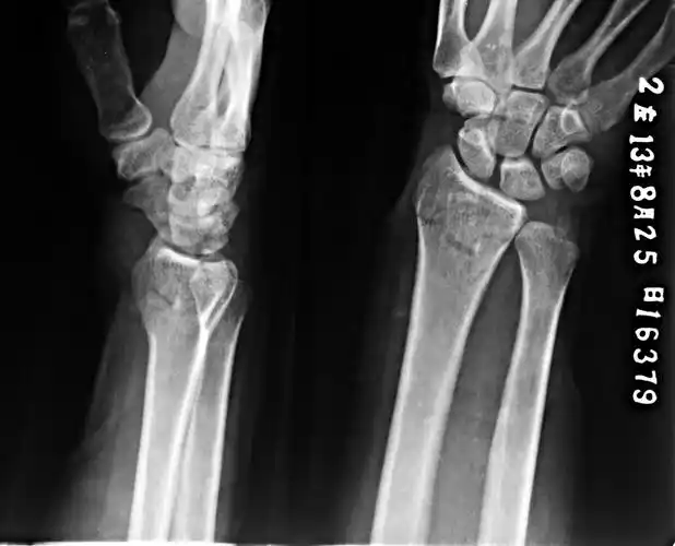 双侧桡骨远端粉碎性骨折闭合复位