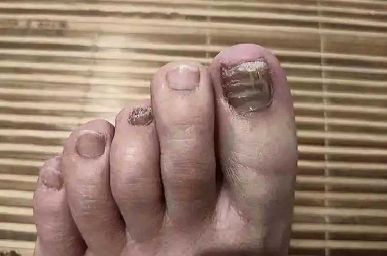 灰指甲又厚又硬怎么办用这一招治标又治本省钱又高效