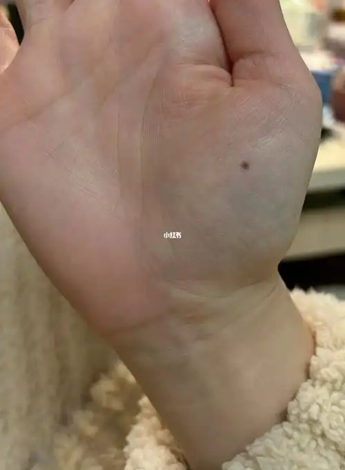 掌心长了一颗痣还越来大了