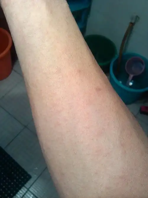 怎么治疗?  83 2009-05-31 我是否在出疹子还是过敏还是?