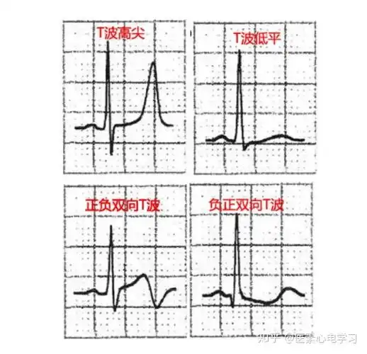 心电图t波改变要命吗很多人都在问