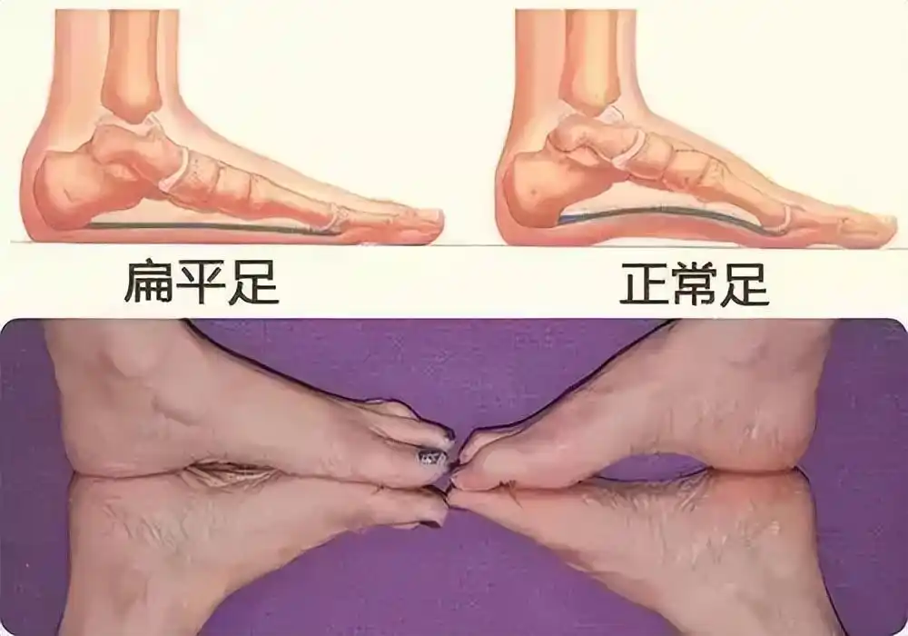 「科普」脚底平一点是正常的吗?教你如何快速判断扁平足