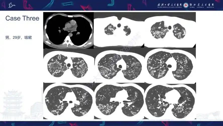 活动性肺结核不典型ct表现