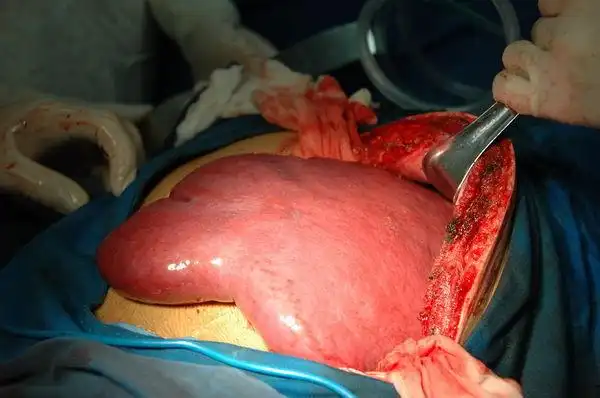 脾脏肿大及脾功能亢进症的手术治疗