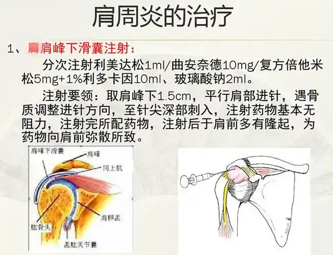 微创注射结合内热针有效治疗肩关节周围炎_肩周炎 - 好大夫在线