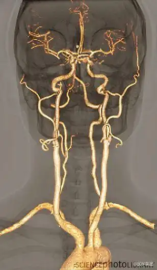 医学美图:大脑供血动脉3d扫描ct成像