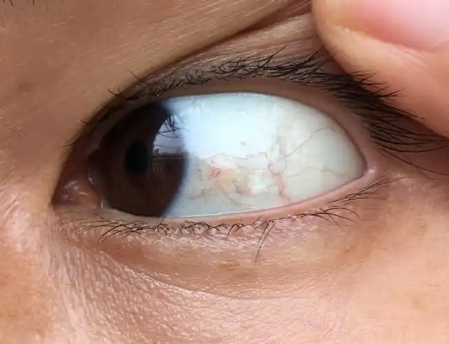 翼状胬肉睑裂斑