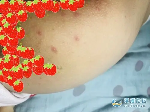 月初的时候孩子臀部开始长了几颗大疙瘩,然后带他到