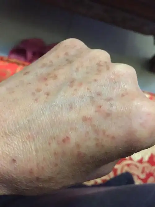 我手背的斑点今天有点红和有点痛.吃东西与平常一样.也无食海鲜.