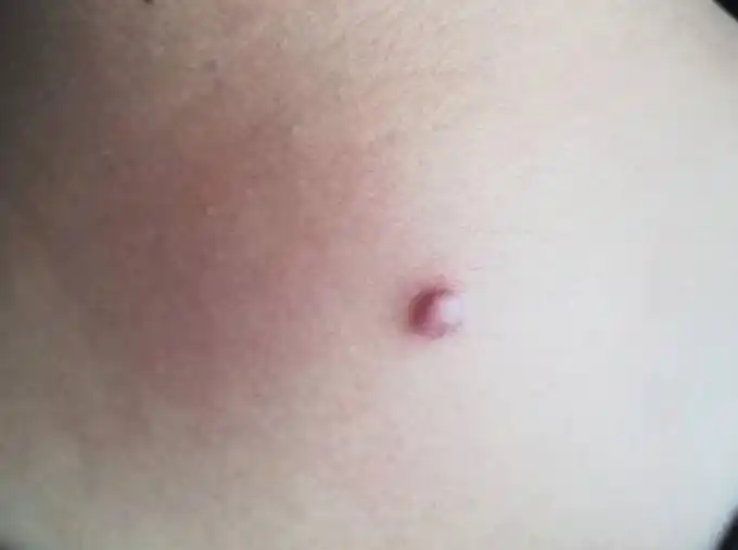 脖子和腋下长"小肉粒"要不要抠掉?