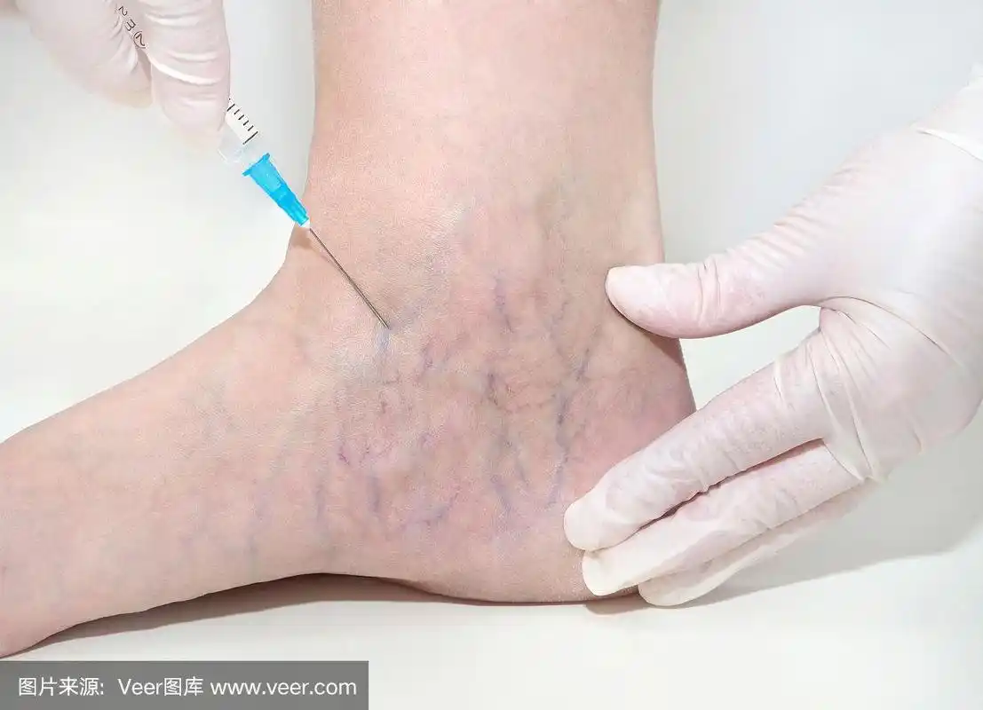 女人腿上的蜘蛛静脉,硬化治疗