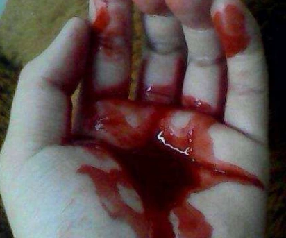 手出血的图片61