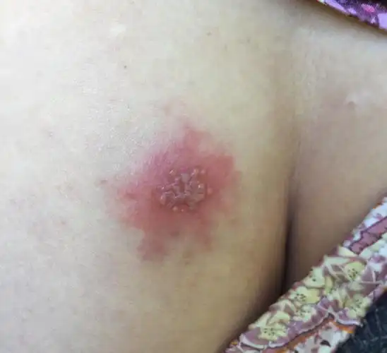 我告诉他,不管发生在哪个部位的带状疱疹,治