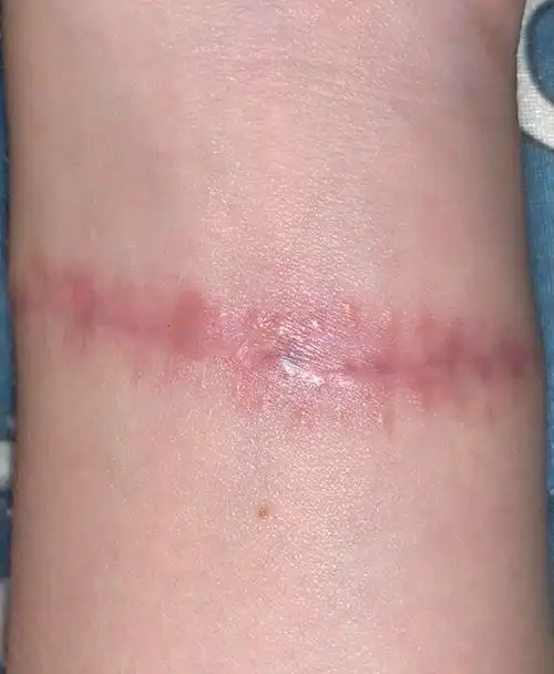 00纹身切除过程及恢复全记录