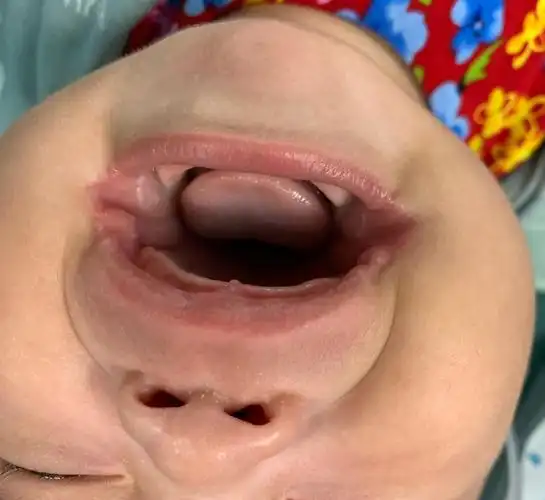 嘉峪关市中医医院开展三个月婴儿先天性面横裂矫正手术