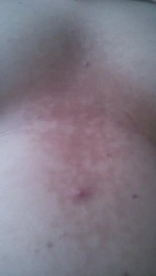 胸前长了一些褐色的斑点不疼不痒而且面积有扩大的趋势差不