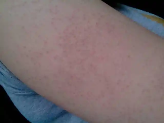 我手臂上长得什么东西啊!拿什么药放才会好.